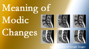 Aaron Chiropractic Clinic sees many back pain and neck pain patients who bring their MRIs with them to the office. Modic changes are often seen. 