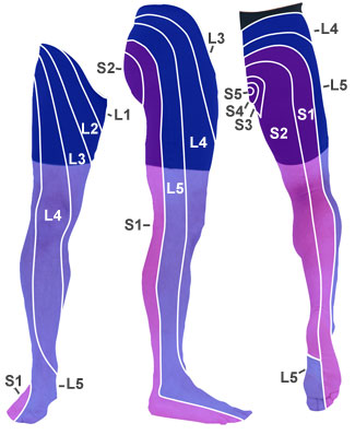 Referred pain in the leg