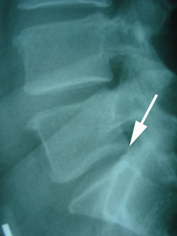 Grade 1 retrolisthesis l5