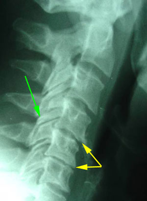 disc degeneration treated at Aaron Chiropractic Clinic