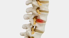 Fort Wayne chiropractic conservative care helps even huge disc herniations go away