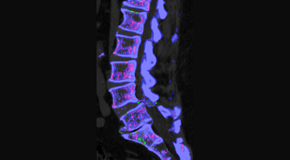 Aaron Chiropractic Clinic is aware that inflammatory spinal gout is a differential diagnosis to consider for patients who present with back pain and other spine related symptoms.