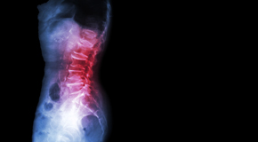 Fort Wayne Chiropractic Care of Spondylolisthesis 