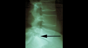 Fort Wayne spondylolisthesis 