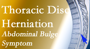 Aaron Chiropractic Clinic treats thoracic disc herniation that for some patients prompts abdominal pain.