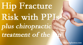 Aaron Chiropractic Clinic shares new research describing increased risk of hip fracture with proton pump inhibitor use. 