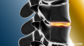 Fort Wayne degenerative spinal changes 