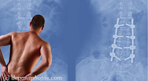 Fort Wayne chiropractic relief for back pain after back surgery
