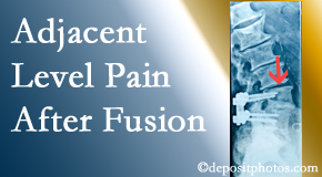 Aaron Chiropractic Clinic offers relieving care non-surgically to back pain patients experiencing adjacent level pain after spinal fusion surgery.