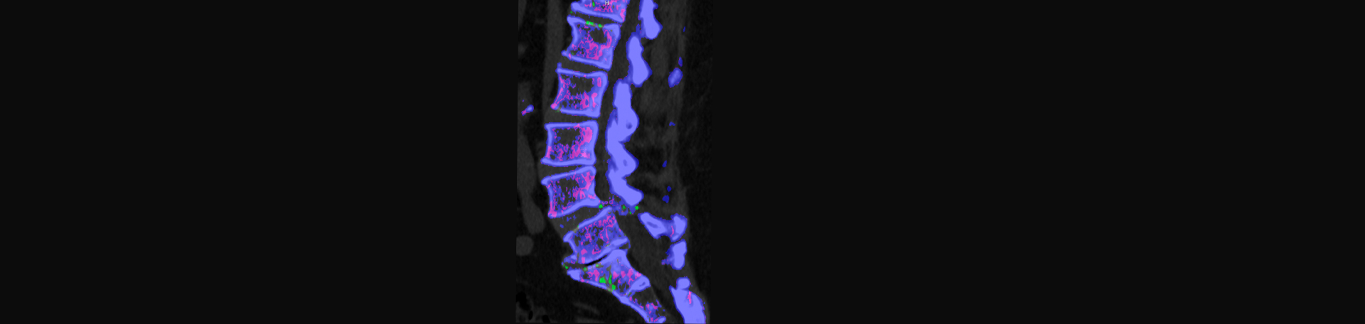 Aaron Chiropractic Clinic is aware that inflammatory spinal gout is a differential diagnosis to consider for patients who present with back pain and other spine related symptoms.