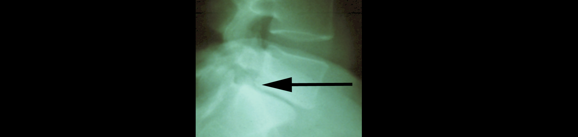 Fort Wayne spondylolisthesis