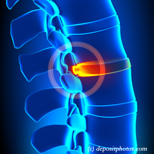 picture of lumbar Fort Wayne disc herniation