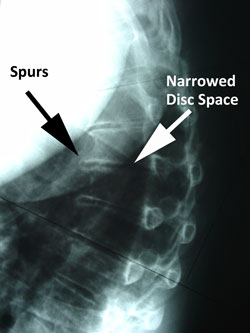 thoracic degenerative degeneration chiropractic